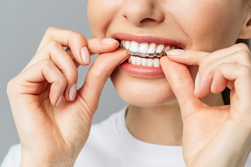 Discreet Smile Transformation: Understanding Clear Aligner Treatment Options